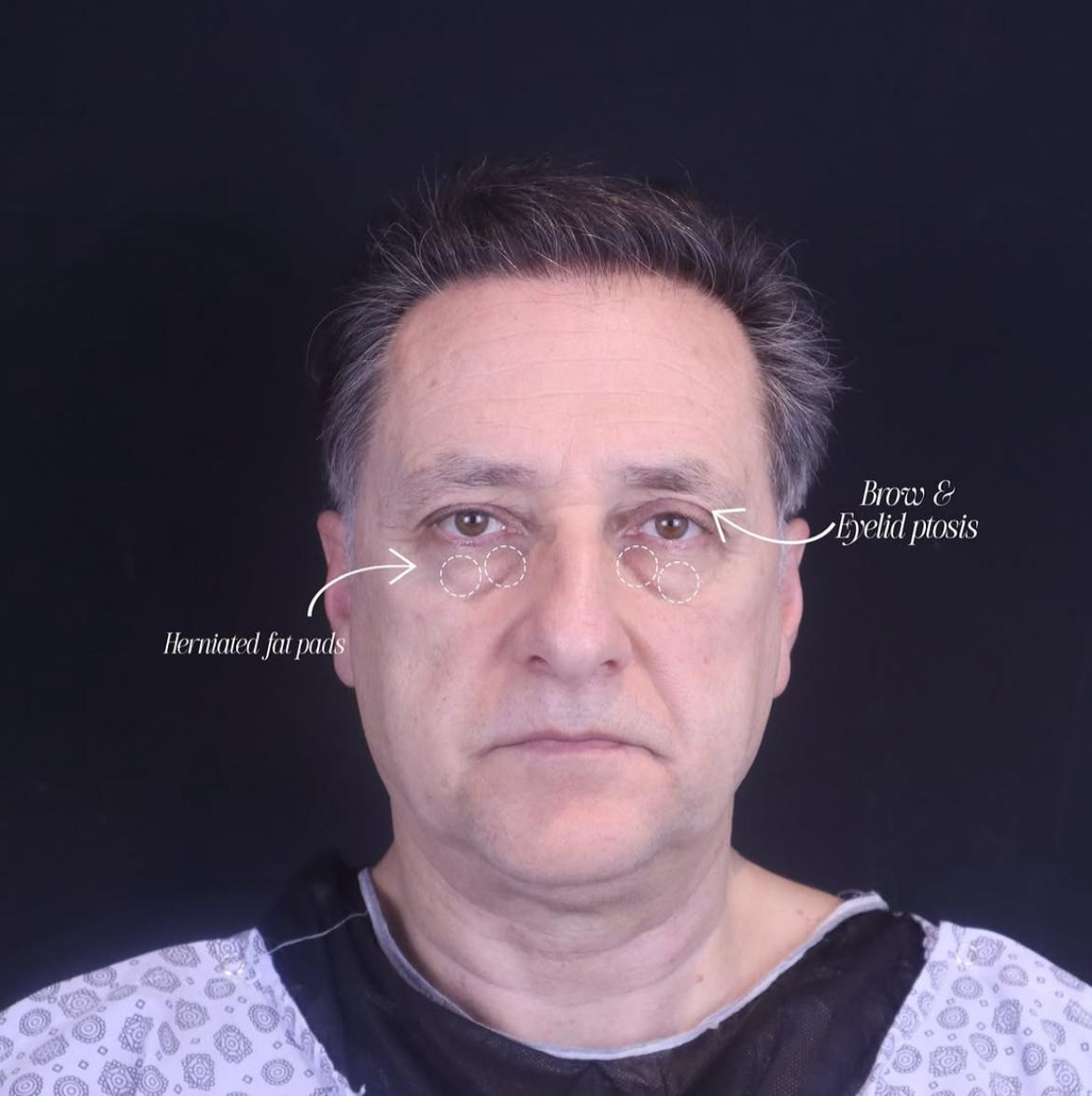 Eyelid Surgery