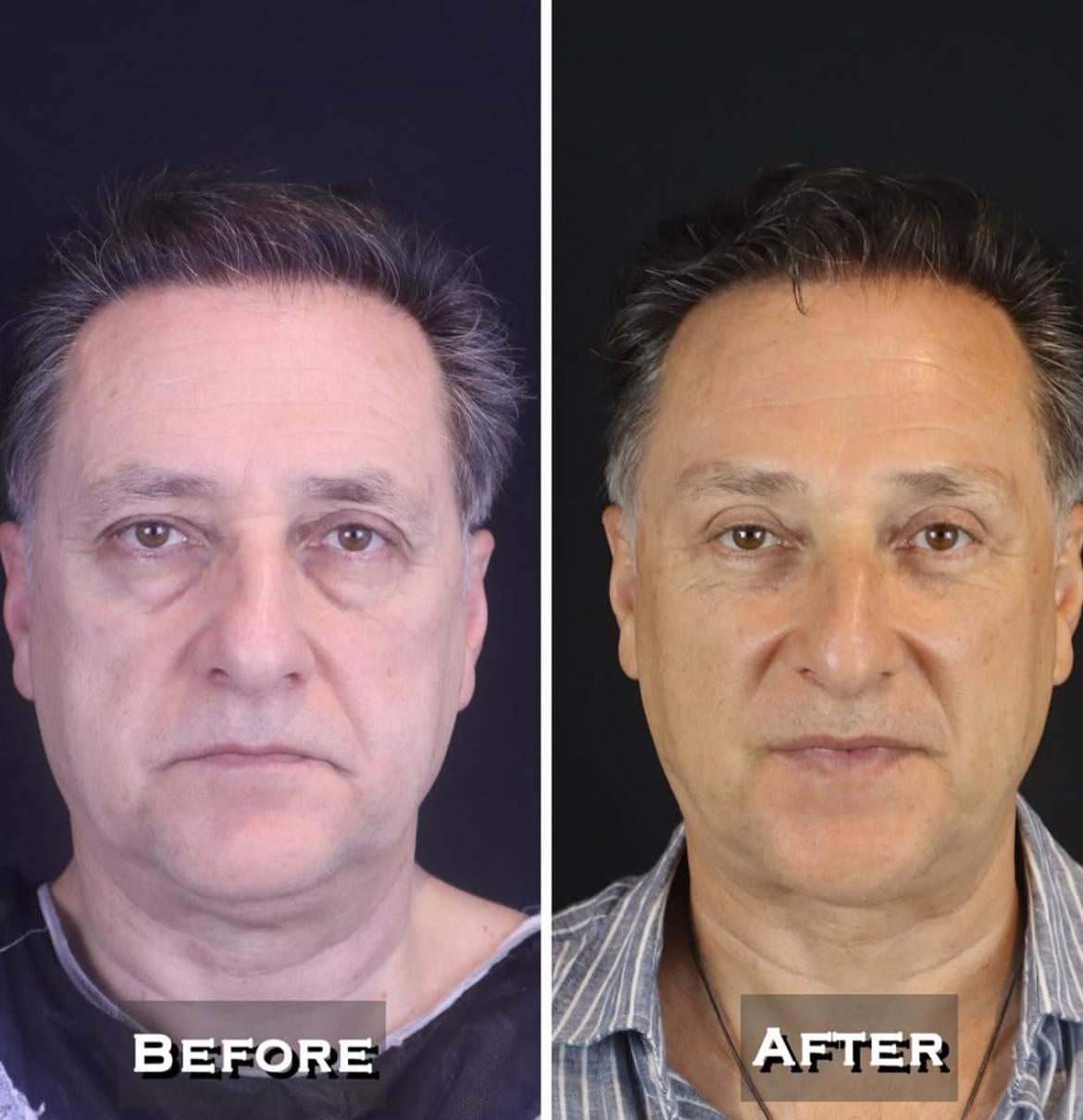 Eyelid Surgery