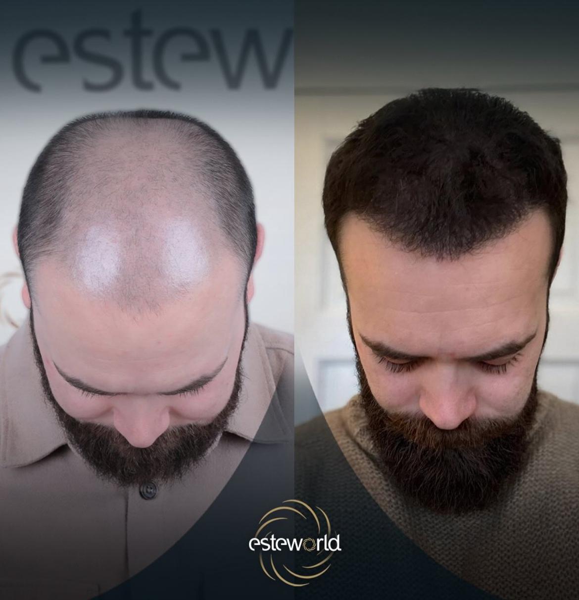Hair Transplant