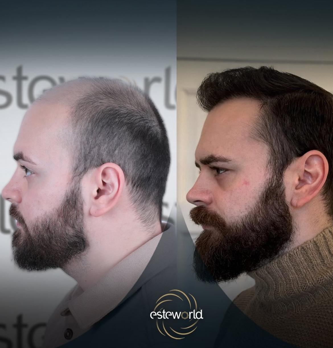 Hair Transplant