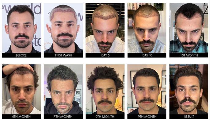 Hair Transplant