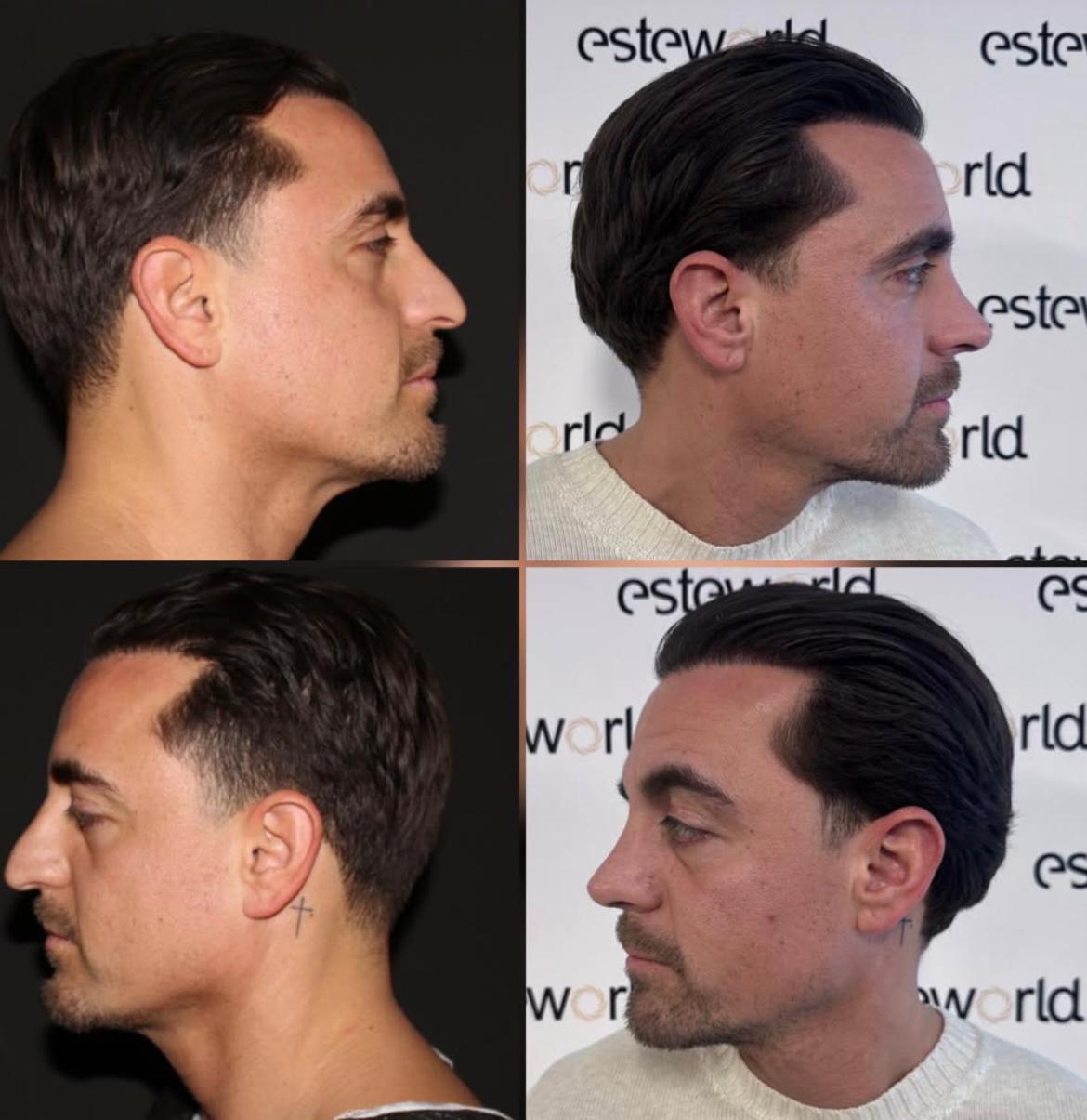 Hair Transplant · Hair Transplant