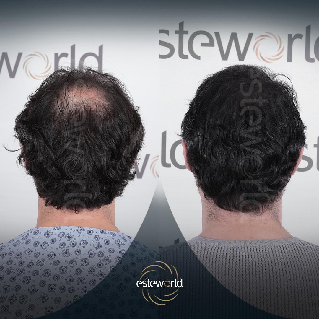 Hair Transplant · Hair Transplant