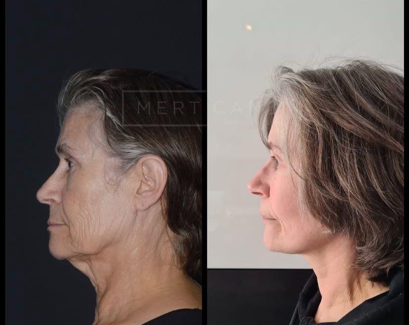 Facelift · Plastic Surgery