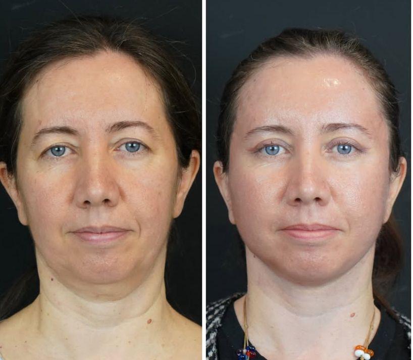 Facial Rejuvenation