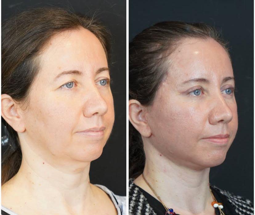 Facial Rejuvenation