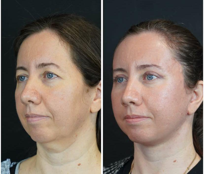 Facial Rejuvenation