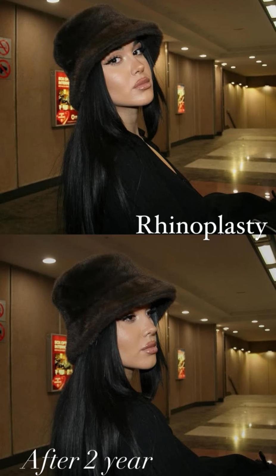 Rhinoplasty · Plastic Surgery