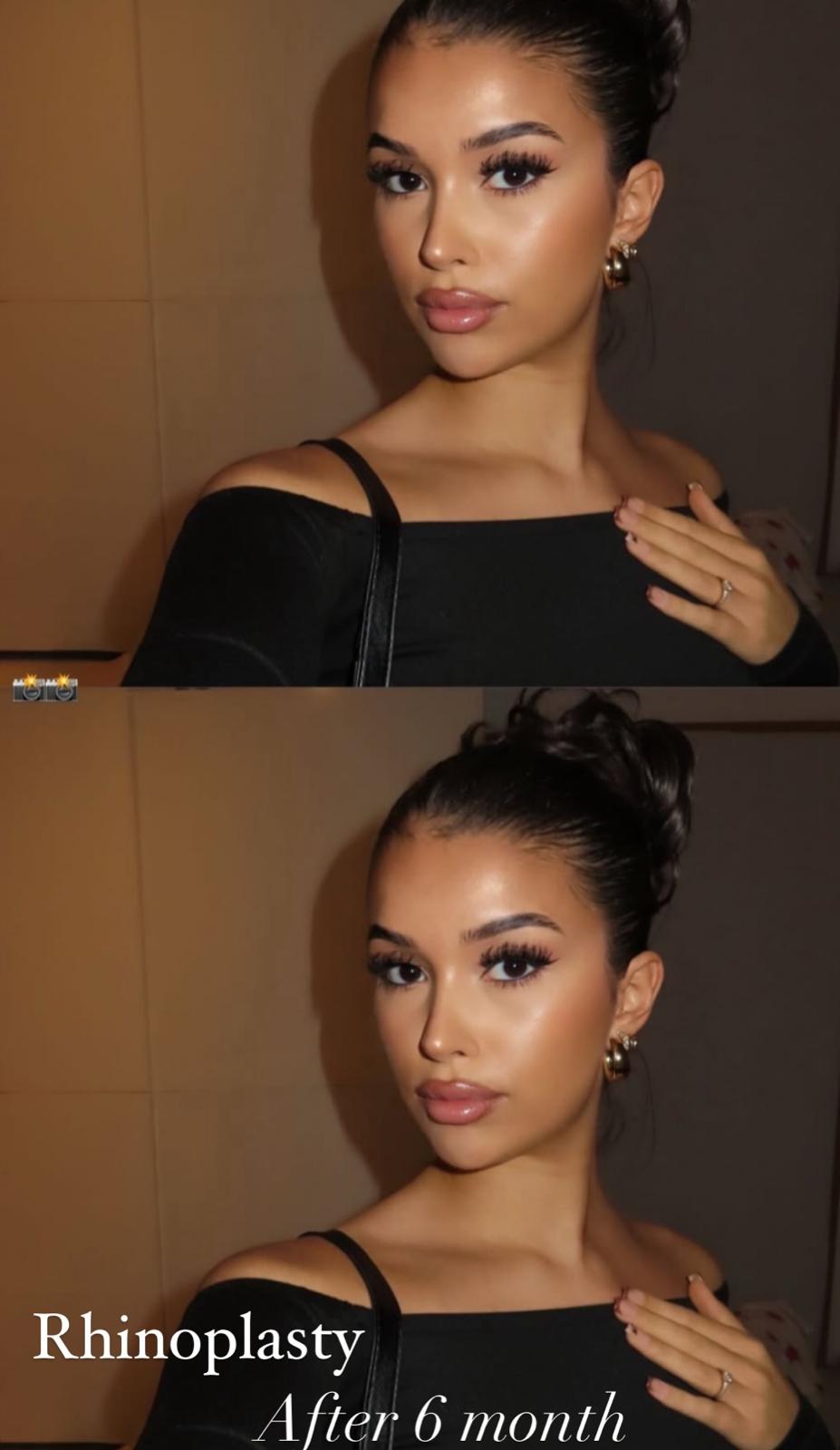 Rhinoplasty · Plastic Surgery