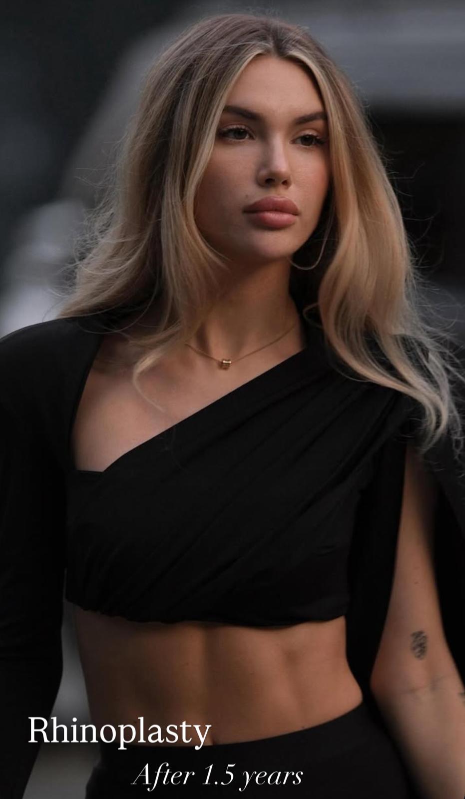 Rhinoplasty · Plastic Surgery