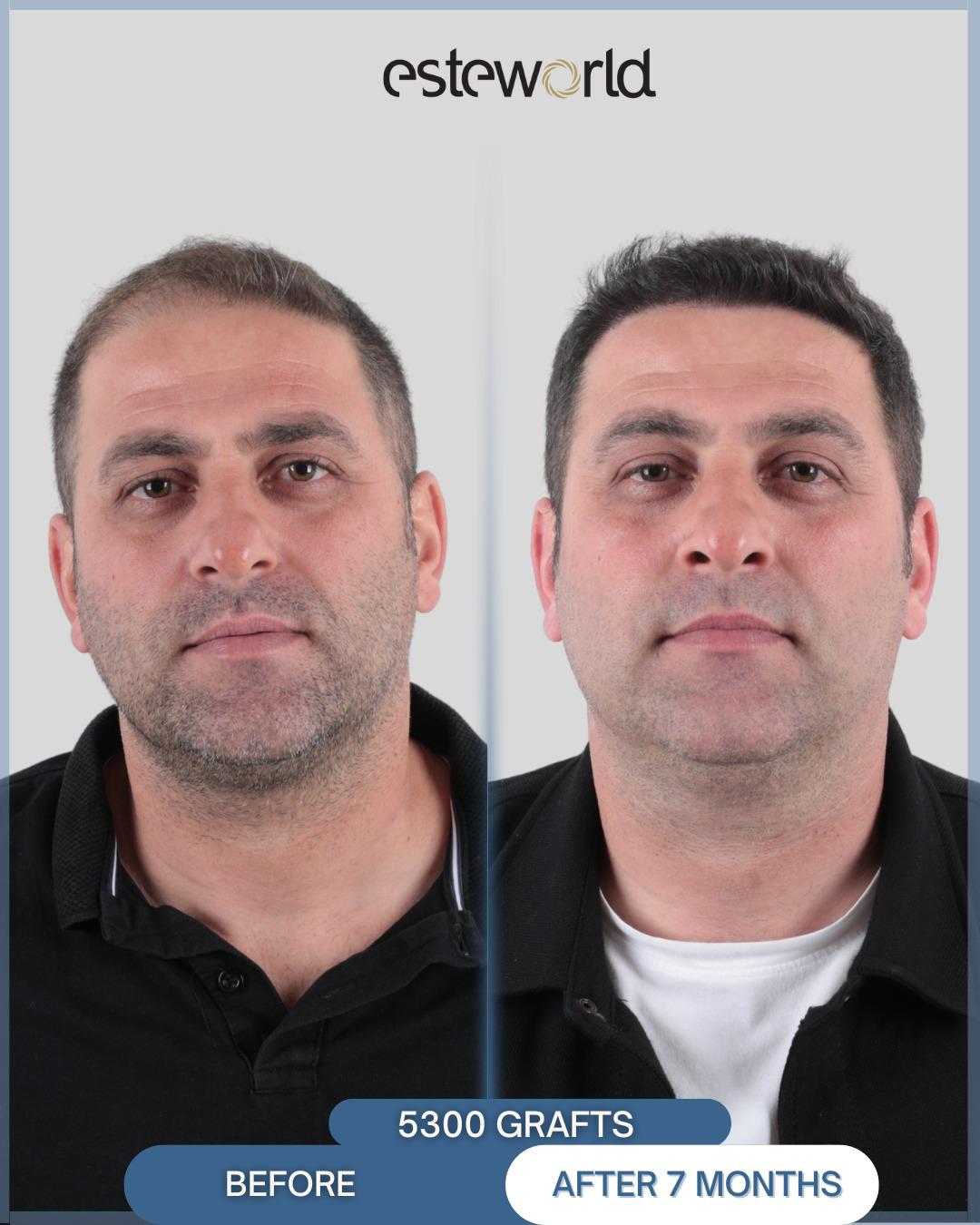 Hair Transplant · Hair Transplant