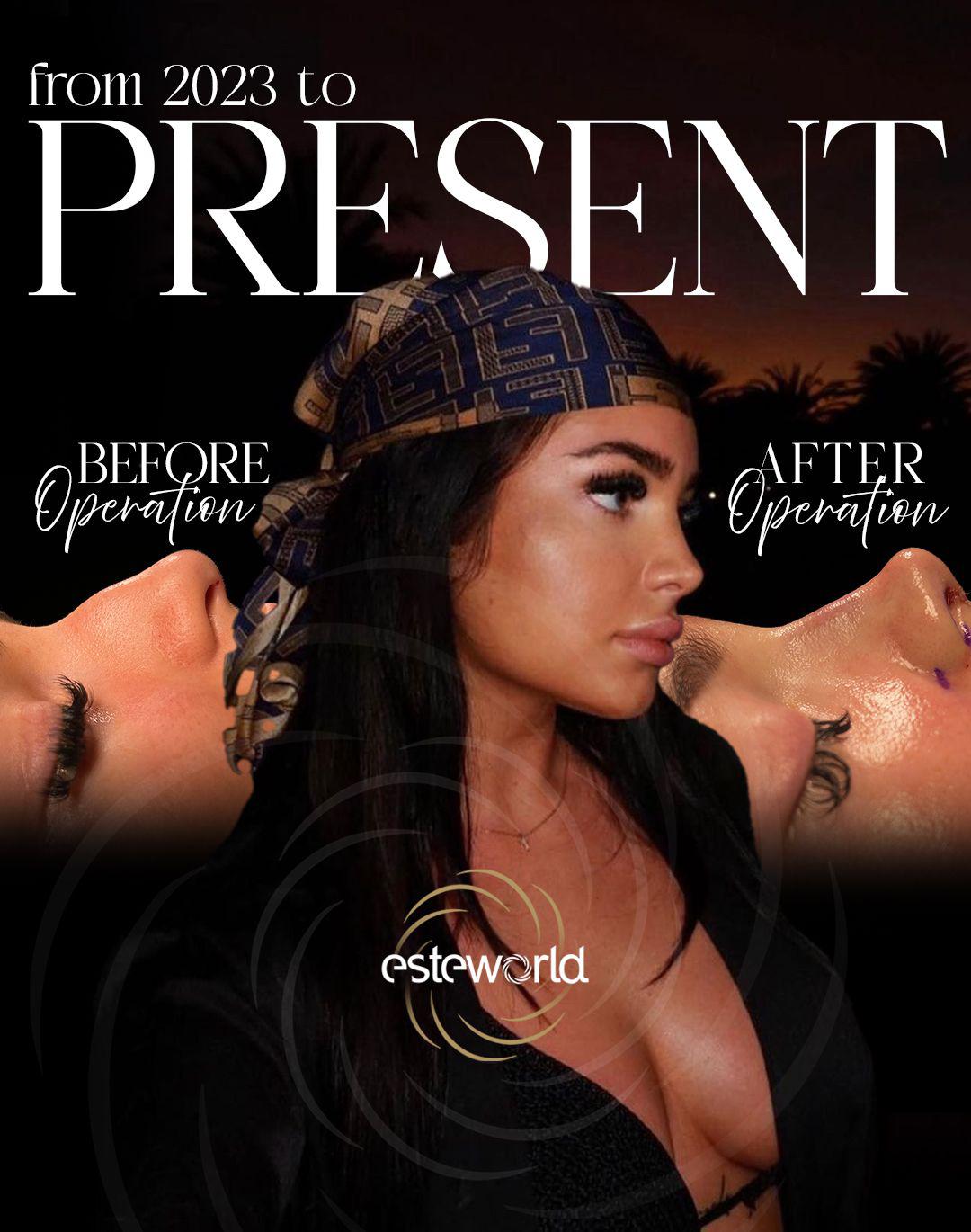 Rhinoplasty · Plastic Surgery