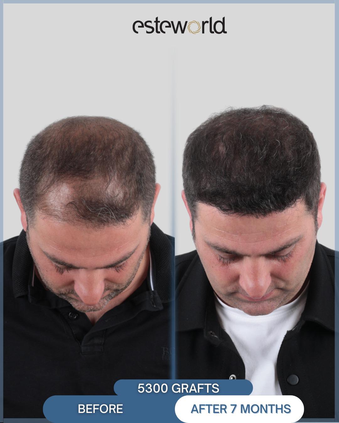 Hair Transplant · Hair Transplant