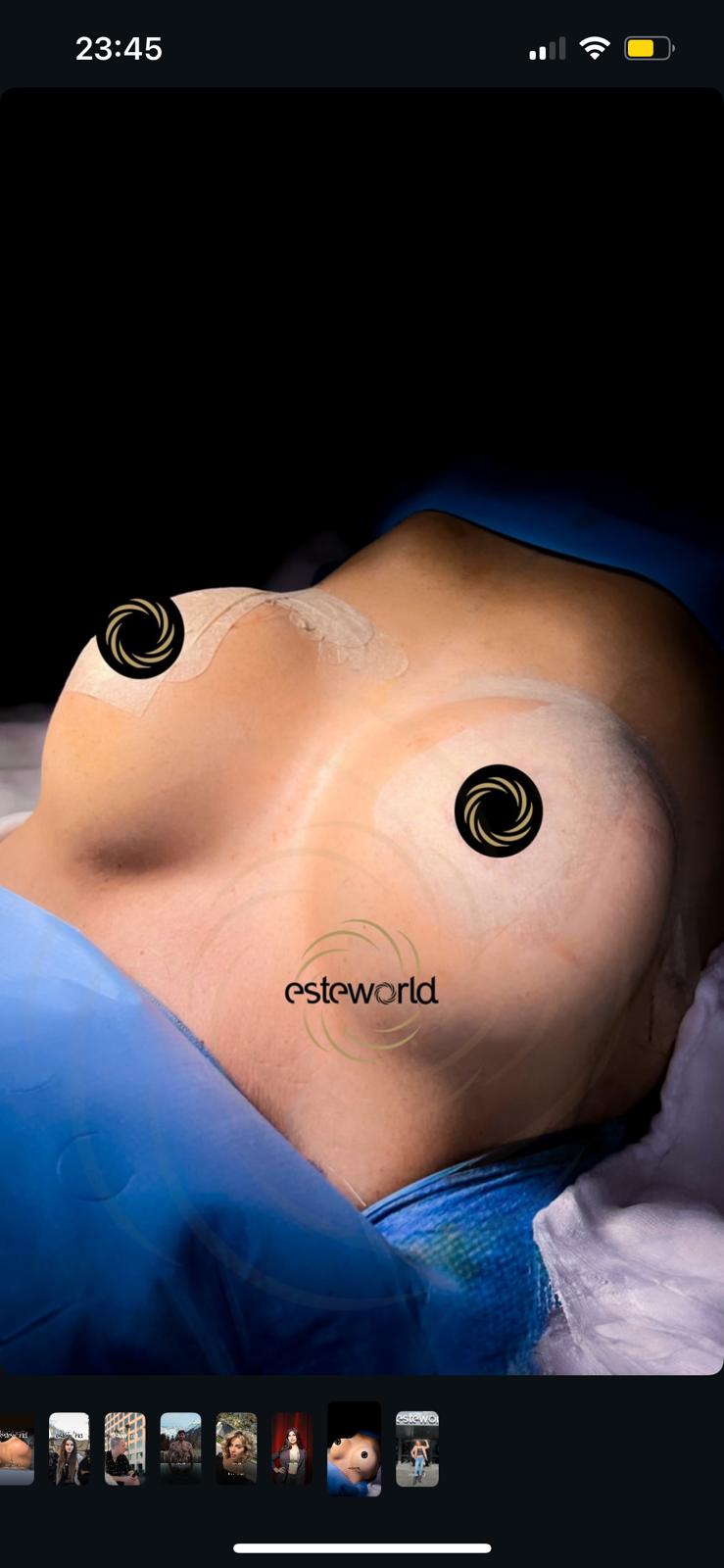Breast Augmentation · Plastic Surgery