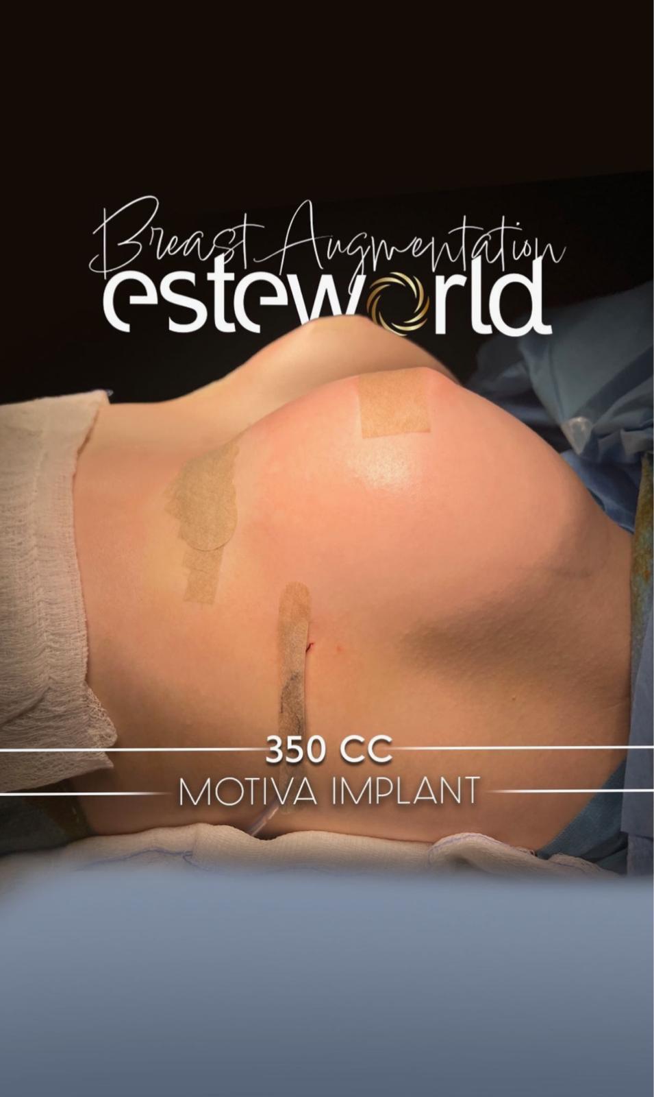 Breast Augmentation · Plastic Surgery
